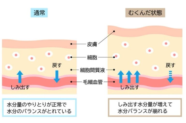 むくみ状態イラスト