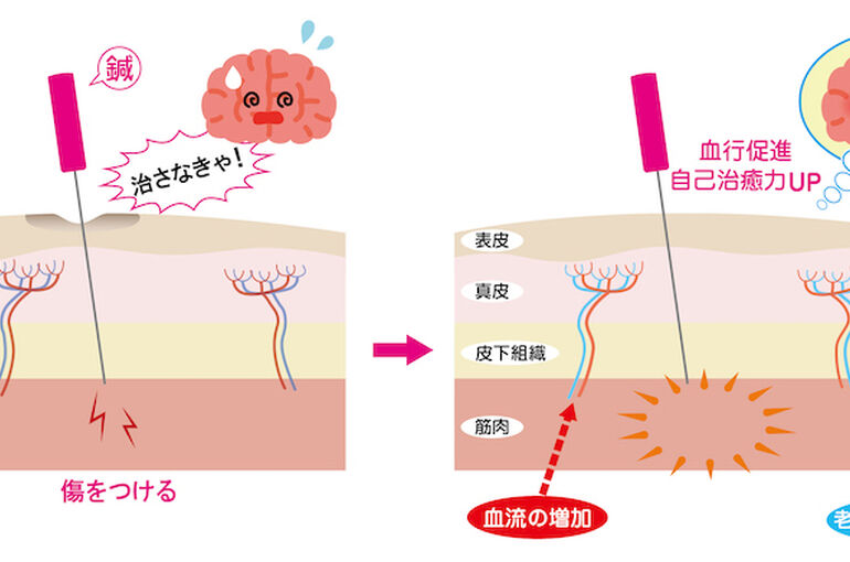 血流改善イメージ