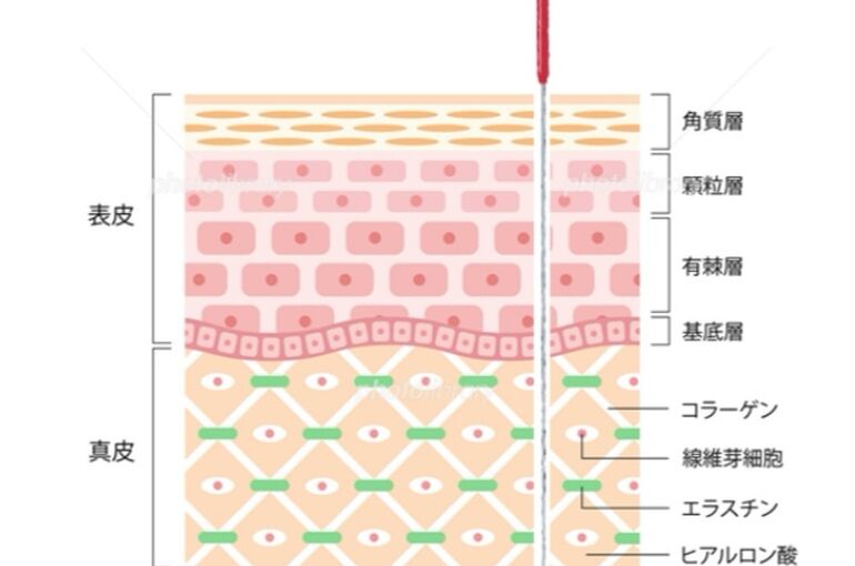 肌構造鍼挿入