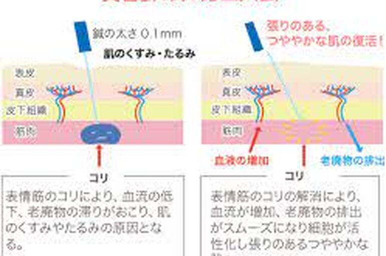 美容鍼のメカニズム