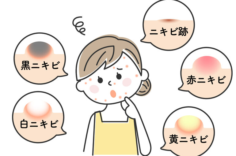 ニキビ種類イラスト