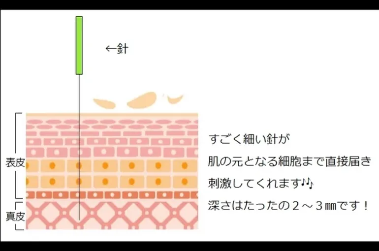 鍼挿入内部いら