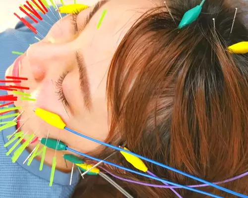 美容鍼施術中